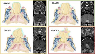 Relationship with the diaphragm to predict the surgical outcome in large and giant pituitary adenomas